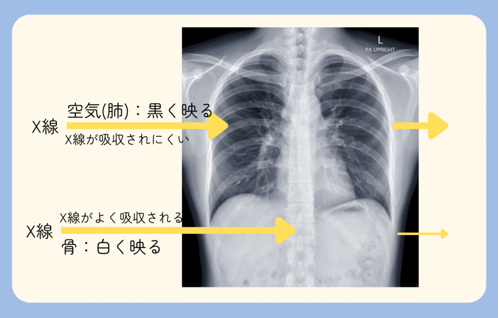 レントゲン検査：X線の吸収と画像の白黒