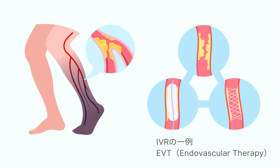 EVT(Endovascular Therapy)のイメージ
